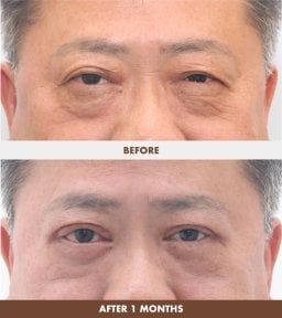 Résultats avant/après lifting chez Dr. Tak Plastic Surgery, rajeunissement du contour des yeux