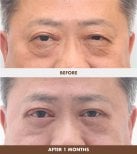 Résultats avant/après lifting chez Dr. Tak Plastic Surgery, rajeunissement du contour des yeux