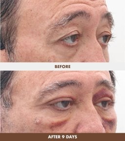 Résultats lifting visage avant et après 9 jours chez Dr. Tak Plastic Surgery, rajeunissement