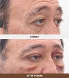 Résultats lifting visage avant et après 9 jours chez Dr. Tak Plastic Surgery, rajeunissement