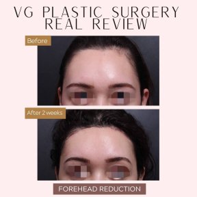 Результати до і після зменшення чола у VG Plastic Surgery, помітний ліфтинг брів