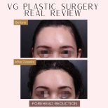 Результати до і після зменшення чола у VG Plastic Surgery, помітний ліфтинг брів