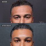 Результати підтяжки брів у VG Plastic Surgery, помітний ефект через 10 днів