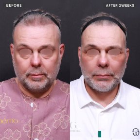 Результати до і після deep plane SMAS підтяжки у VG Plastic Surgery, омолодження обличчя