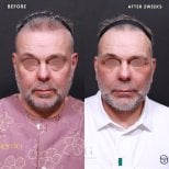 Результати до і після deep plane SMAS підтяжки у VG Plastic Surgery, омолодження обличчя
