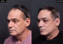 Результат до та після deep plane SMAS підтяжки у VG Plastic Surgery, омолодження обличчя