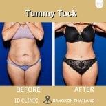 Before and after tummy tuck results at ID Clinic Bangkok showing flatter, toned abdomen