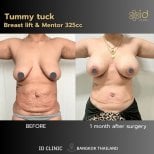 Before and after tummy tuck and breast lift with implants at ID Clinic Bangkok, visible results