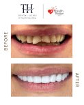 Hollywood Smile Vorher-Nachher-Ergebnis bei TH Dental Clinic – strahlendes, gleichmäßiges Lächeln