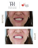 Hollywood Smile Vorher-Nachher-Ergebnis bei TH Dental Clinic – weißere, gleichmäßige Zähne