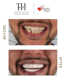 Hollywood Smile Vorher-nachher-Ergebnis bei TH Dental Clinic – sichtbare Veränderung