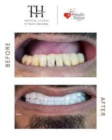 Vorher-nachher-Ergebnis All-on-4-Implantate bei TH Dental Clinic – Lächeln-Transformation