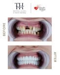 Vorher-nachher-Ergebnis All-on-4-Implantate bei TH Dental Clinic – vollständige Zahnsanierung