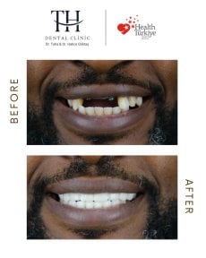 Vorher-nachher-Ergebnis All-on-4-Implantate bei TH Dental Clinic, Lächeln wiederhergestellt