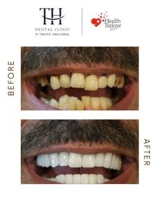 Vorher-nachher-Ergebnis All-on-4-Implantate bei TH Dental Clinic – neues Lächeln
