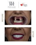 Vorher-nachher-Ergebnis All-on-6 Implantate bei TH Dental Clinic – vollständige Zahnsanierung