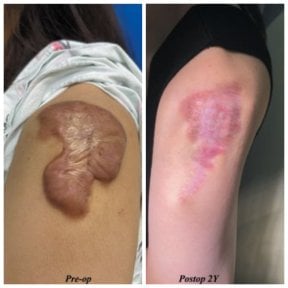 before-after photo skin-grafting-for-burns