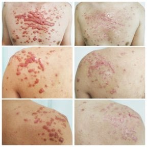 before-after photo skin-grafting-for-burns