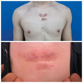 before-after photo skin-grafting-for-burns