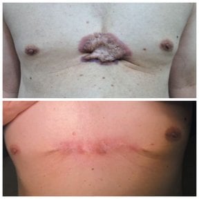 before-after photo skin-grafting-for-burns