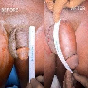 before-after photo penis-enlargement