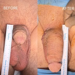 before-after photo penis-enlargement
