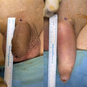 before-after photo penis-enlargement