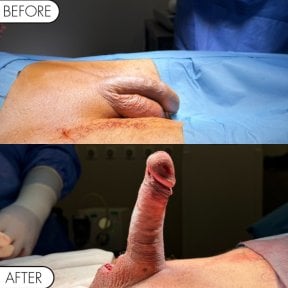 before-after photo penile-implant-surgery