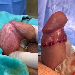 before-after photo penile-curvature-correction-surgical-treatment-for-peyronies-disease