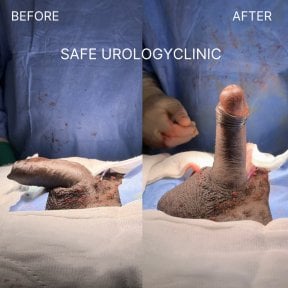 before-after photo penile-implant-surgery