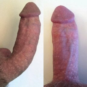 before-after photo penile-curvature-correction-surgical-treatment-for-peyronies-disease