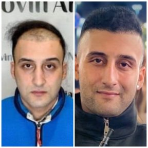 before-after photo sapphire-fue-hair-transplant