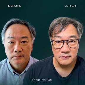 before-after photo sapphire-fue-hair-transplant