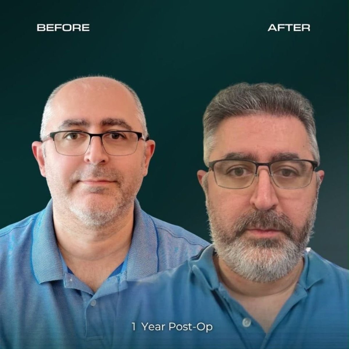 Resultado de trasplante capilar Sapphire FUE antes y después en NOVİN ARİANA SAĞLIK VE TURİZM LİMİTED ŞİRKETİ