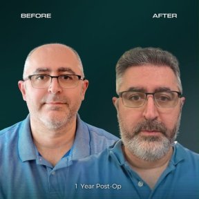 before-after photo sapphire-fue-hair-transplant