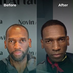 before-after photo sapphire-fue-hair-transplant