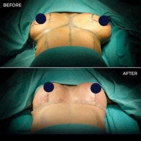 before-after photo breast-reduction
