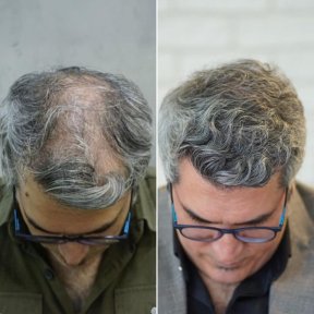 before-after photo fue-hair-transplant