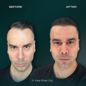 before-after photo fue-hair-transplant