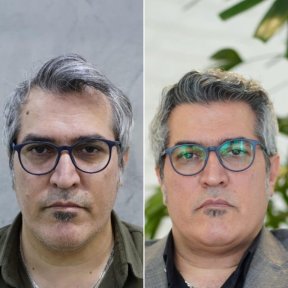 before-after photo fue-hair-transplant