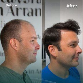 before-after photo fue-hair-transplant