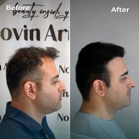 before-after photo fue-hair-transplant