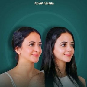 before-after photo revision-rhinoplasty