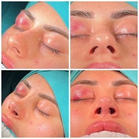 before-after photo revision-rhinoplasty