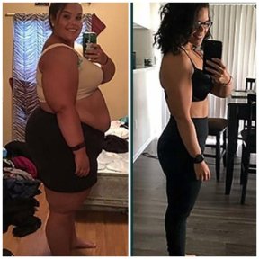 before-after photo sleeve-resection