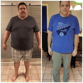 before-after photo sleeve-resection