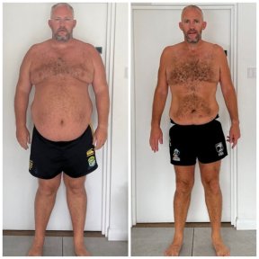before-after photo sleeve-resection