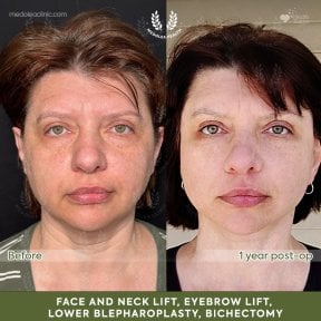 before-after photo rhinoplasty-nose-job