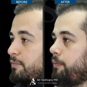 before-after photo rhinoplasty-nose-job