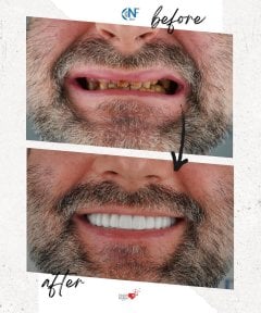 before-after photo installation-of-a-veneer